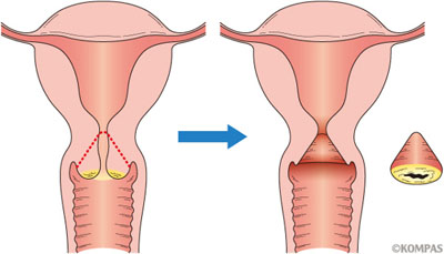 子宮頸癌に対する円錐切除術