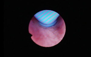 卵管鏡のみで治療する場合